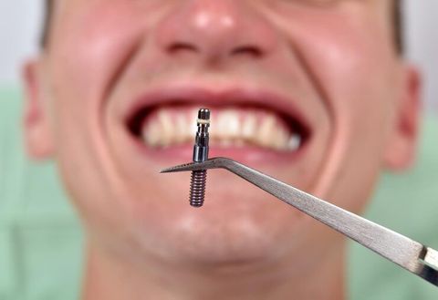Screw in Teeth Overview: Modern Dental Implant Explanation and Care Tips