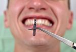 Screw in Teeth Overview: Modern Dental Implant Explanation and Care Tips